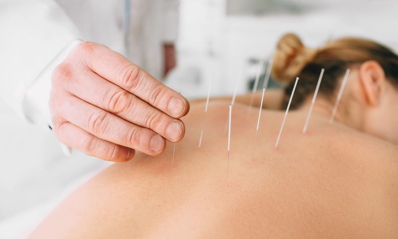 Acupuncture