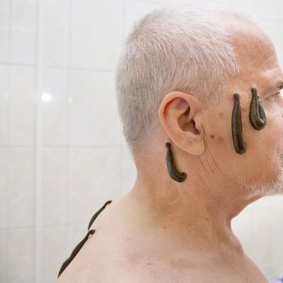 Leech Treatment (Hirudotherapy)